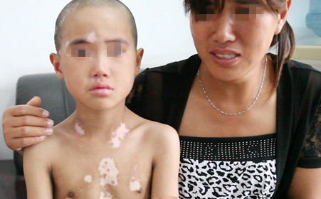 白癜风图片 白癜风图片