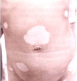 白癜风图片 白癜风图片