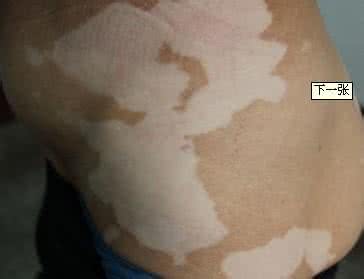白癜风 白癜风